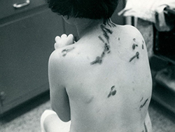 The back of a young resident showing wounds in the shape of keys, resulting from being beaten by a staff member using their heavy metal keys. She holds her arms close to her chest as she is hunched over.